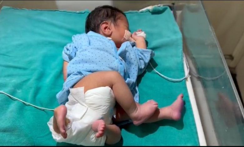 मेडिकल कालेज मेरठ में चार हाथ एवम चार पांव वाले नवजात का ईलाज किया जा रहा है 1 111 33