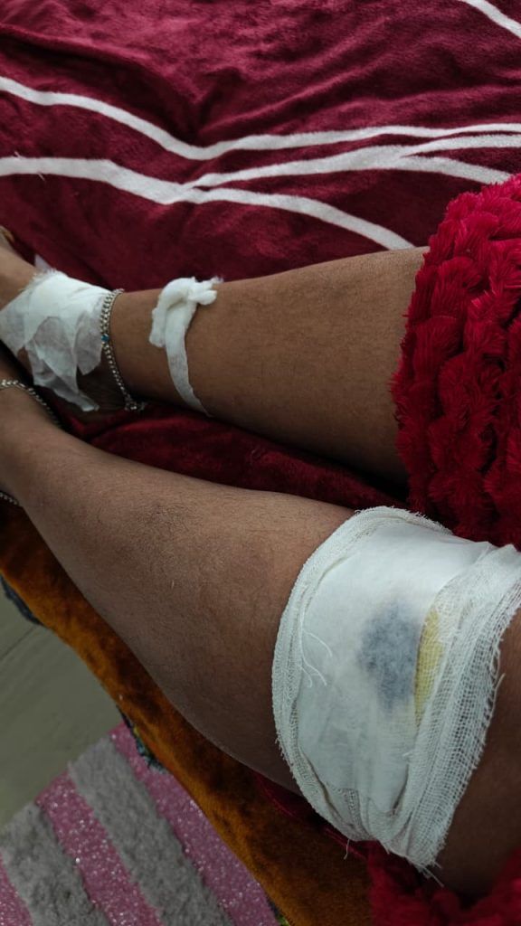 निलाया ग्रीन्स रोड की बदहाल हालत बनी हादसे की वजह 1 111 11