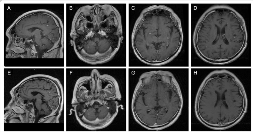 MRI brain scan with gadolinium contrast showing detailed T1-weighted images of brain structures.
