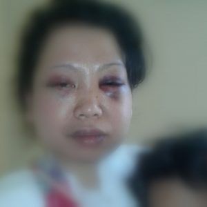 Ternyata, Wanita Ini Babak Belur Dihajar Suaminya Sendiri