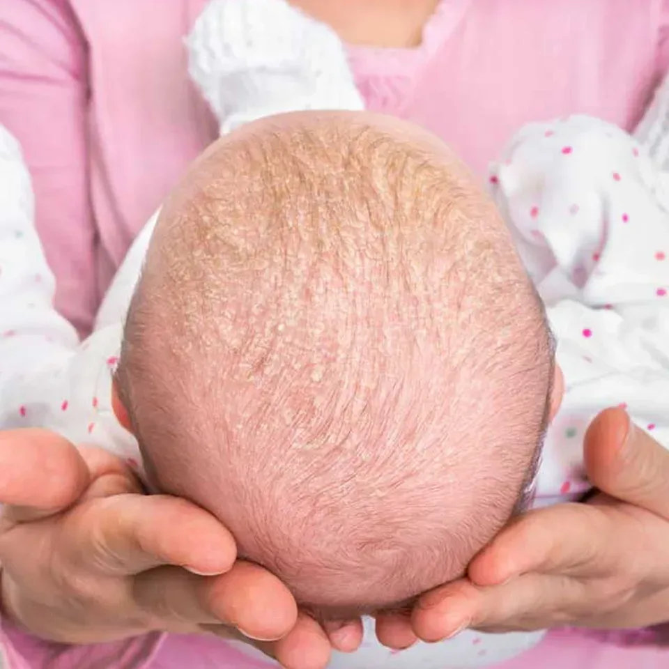 HM Nens on X: La costra láctea es el nombre como se conoce coloquialmente  a la dermatitis seborreica del bebé, que afecta sobre todo al cuero  cabelludo. Conoce las causas y cómo