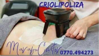 Criolipoliza Criolipoliza