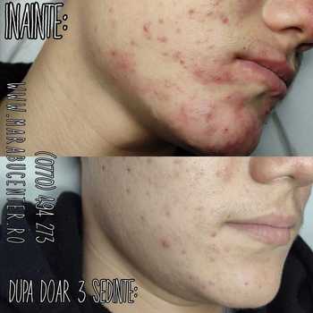 Tratament facial anti-acneic si masca 1 Tratament facial anti-acneic si masca