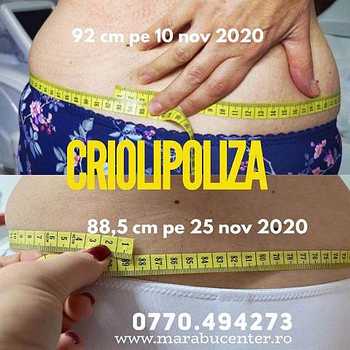 Salon_Marabu_criolipoliza(1) Salon_Marabu_criolipoliza(1)