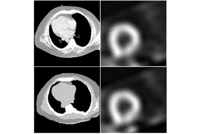 SPECT images (right) and attenuation maps (left) obtained by traditional methods (top) and the new CTLESS method (bottom). (Image: Jha Lab)