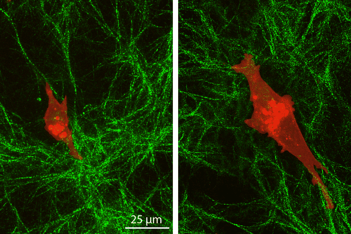 Image showing single cancer cells (MDA-MB-231, red) on top of collagen (green) layers with soft (left) or stiff (right) underlying polyacrylamide hydrogels. This study reveals a feedback mechanism in cancer cells, but not normal cells, that allows them to sense stiffness deep into layered extracellular matrices. Scale bar, 25 μm. (Credit: Christopher Walter, Department of Mechanical Engineering & Materials Science)