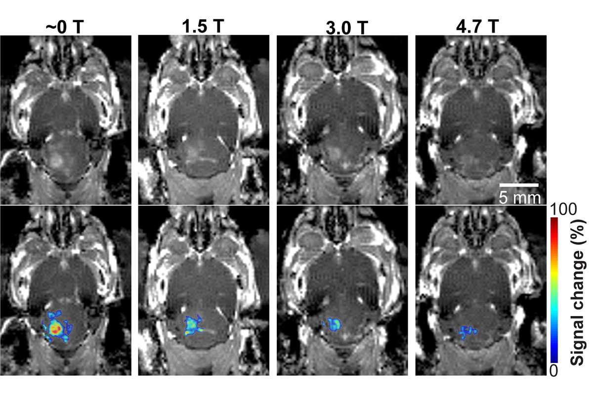 In a mouse model study of MRI-guided focused ultrasound-induced blood-brain barrier (BBB) opening at MRI field strengths ranging from ­approximately 0 T (outside the magnetic field) to 4.7 T, the static magnetic field dampened the detected microbubble cavitation signal and decreased the BBB opening volume. 