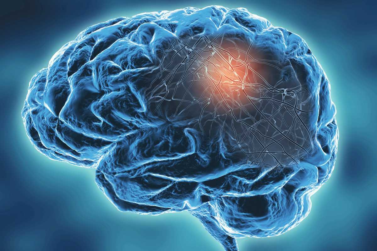 A Washington University in St. Louis team has collaborated to create an imaging method that allows them to get an accurate measurement of dopamine transporter, a protein important in movement, in three regions in the brain associated with Parkinson’s disease. (iStock photo)