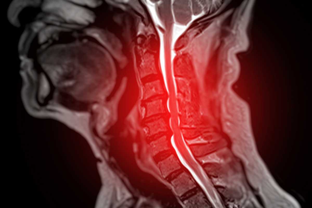 A multidisciplinary team of surgeon-scientists, computer scientists and researchers developed an artificial intelligence-based approach that could help clinicians screen for and diagnose cervical spondylotic myelopathy up to 30 months earlier, opening new opportunities for earlier treatment. (iStock photo)