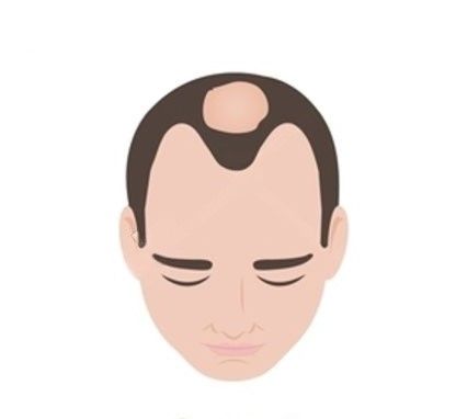 Stage 3