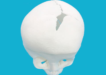 Unicoronal Craniosynostosis