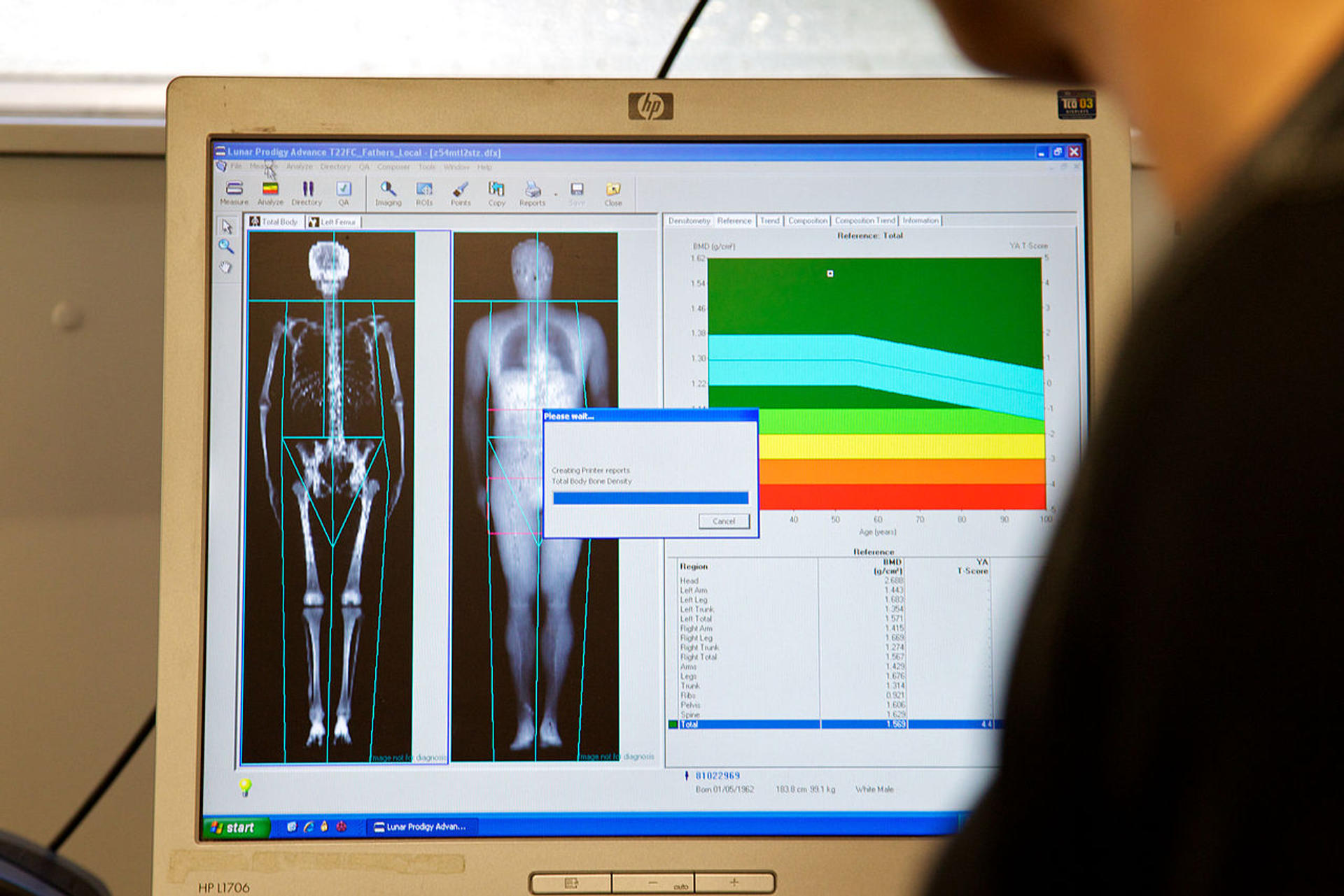 Screen showing a DEXA scan