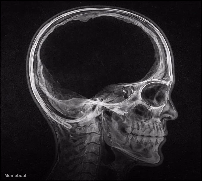 90% Brain Mass Missing / No Brainer - meme generator image preview