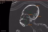 Alien Head CT Scan