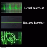 normal heartbeat deceased heartbeat