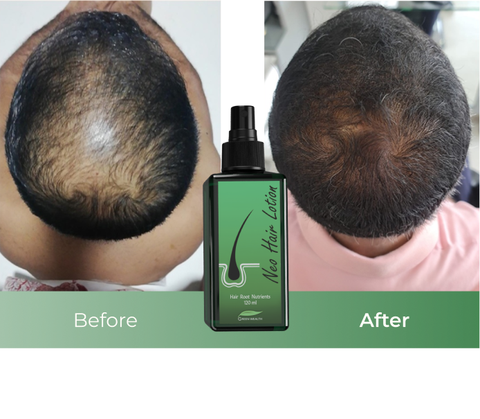 Amazon.com : Green Wealth Neo Hair Lotion, 120 ml Hair