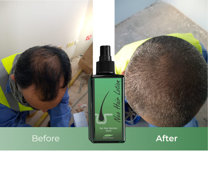 Regrow Hair with Neo Hair Lotion in Dubai | Green Wealth, UAE Regrow Hair with Neo Hair Lotion in Dubai | Green Wealth, UAE