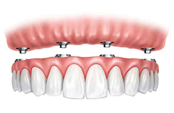 Nepean Dental Implants Dentistry - Dentists In Penrith