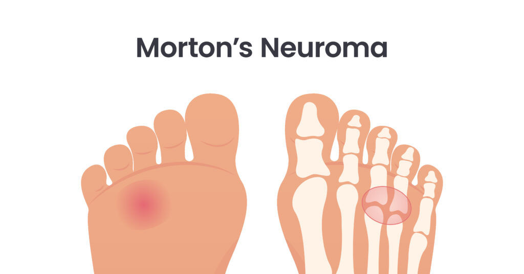 illustration of foot anatomy for Morton's Neuroma