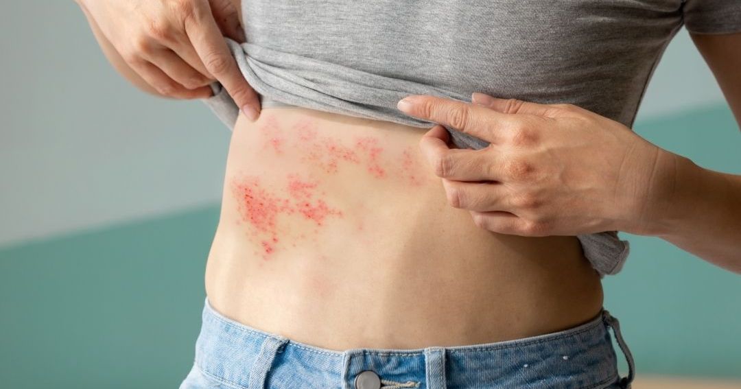 Person lifting gray T-shirt to reveal red shingles rash across the right side of the abdomen near the waist.