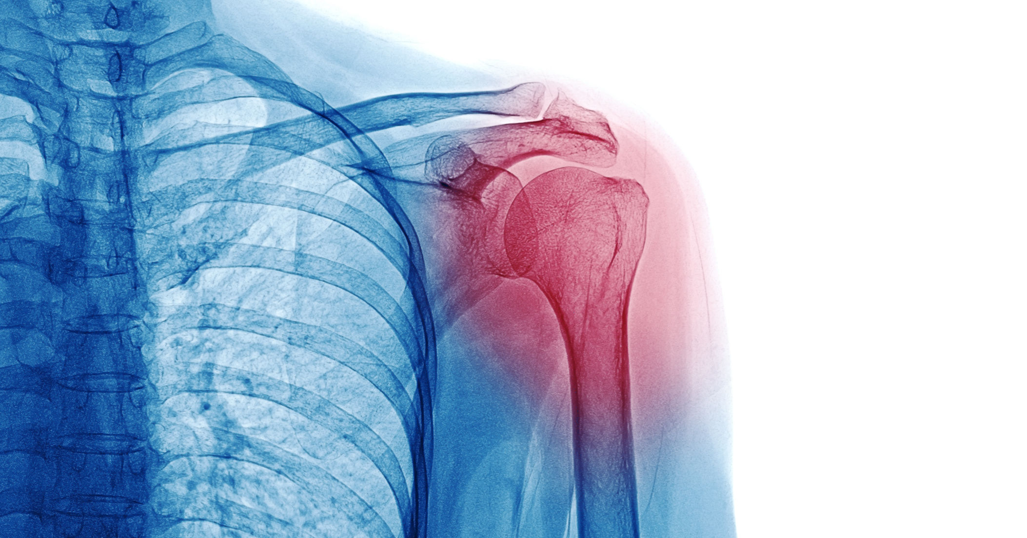 X Ray image of patient who have shoulder pain isol