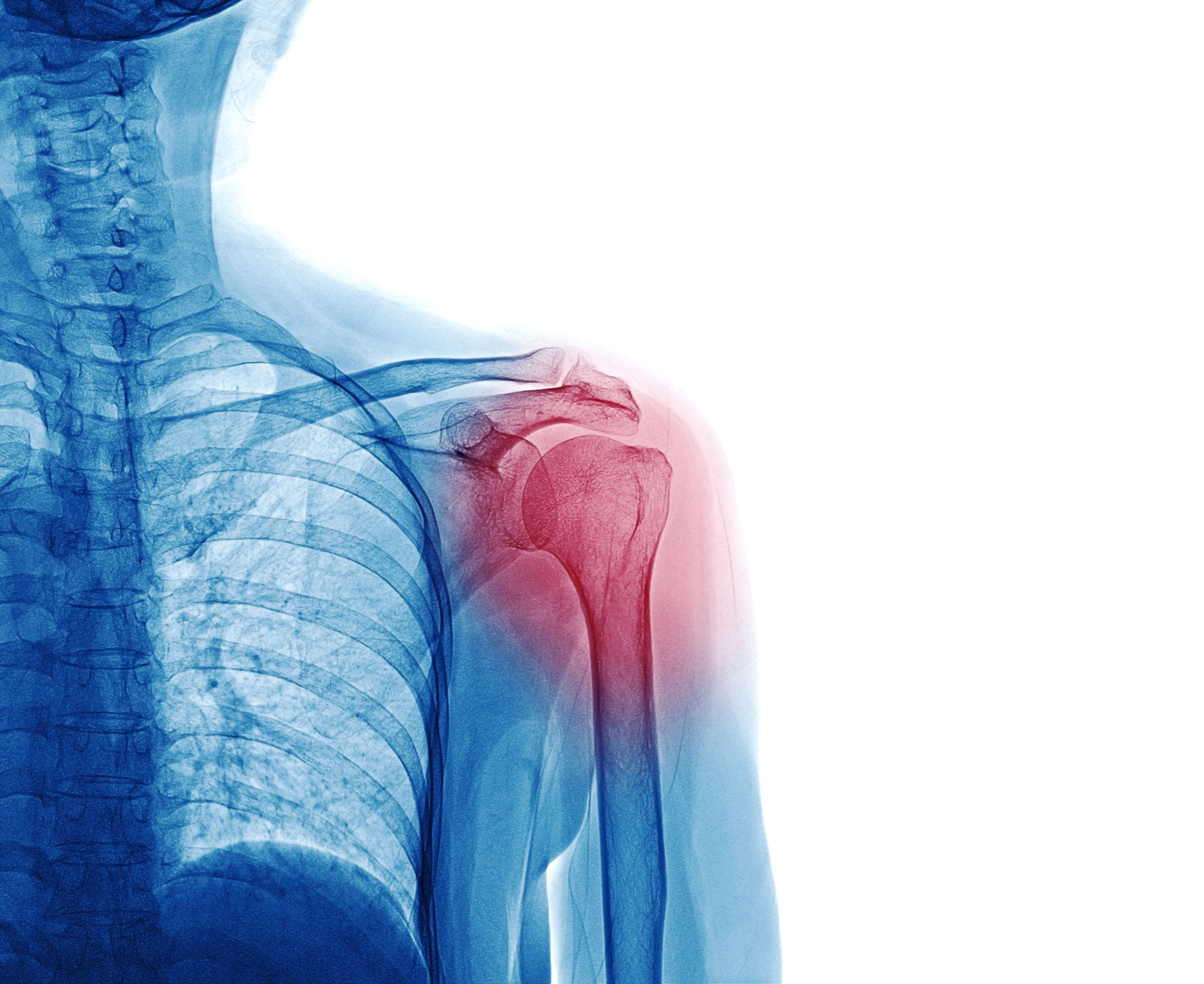 X Ray image of patient who have shoulder pain isol
