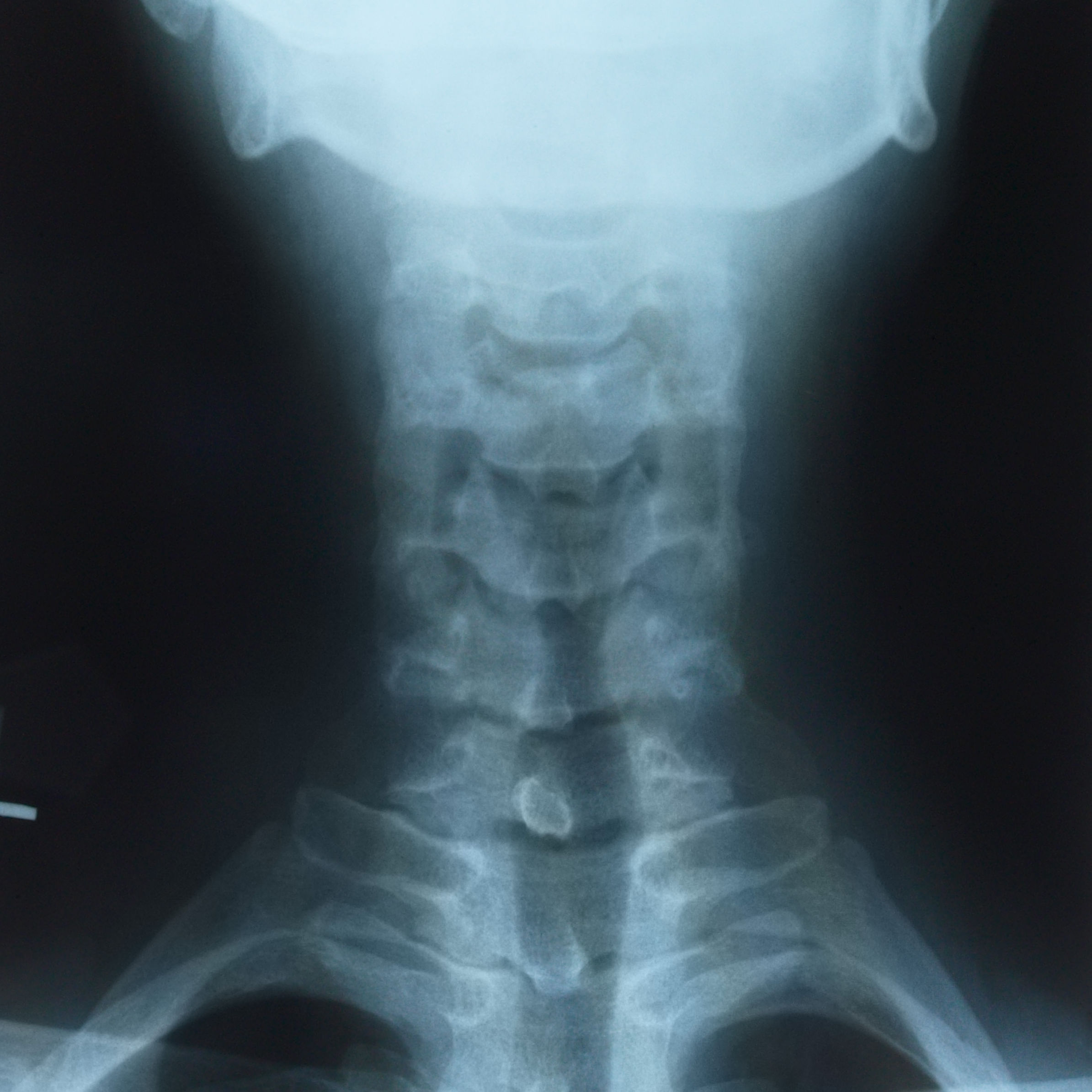 X-ray of neck from rear