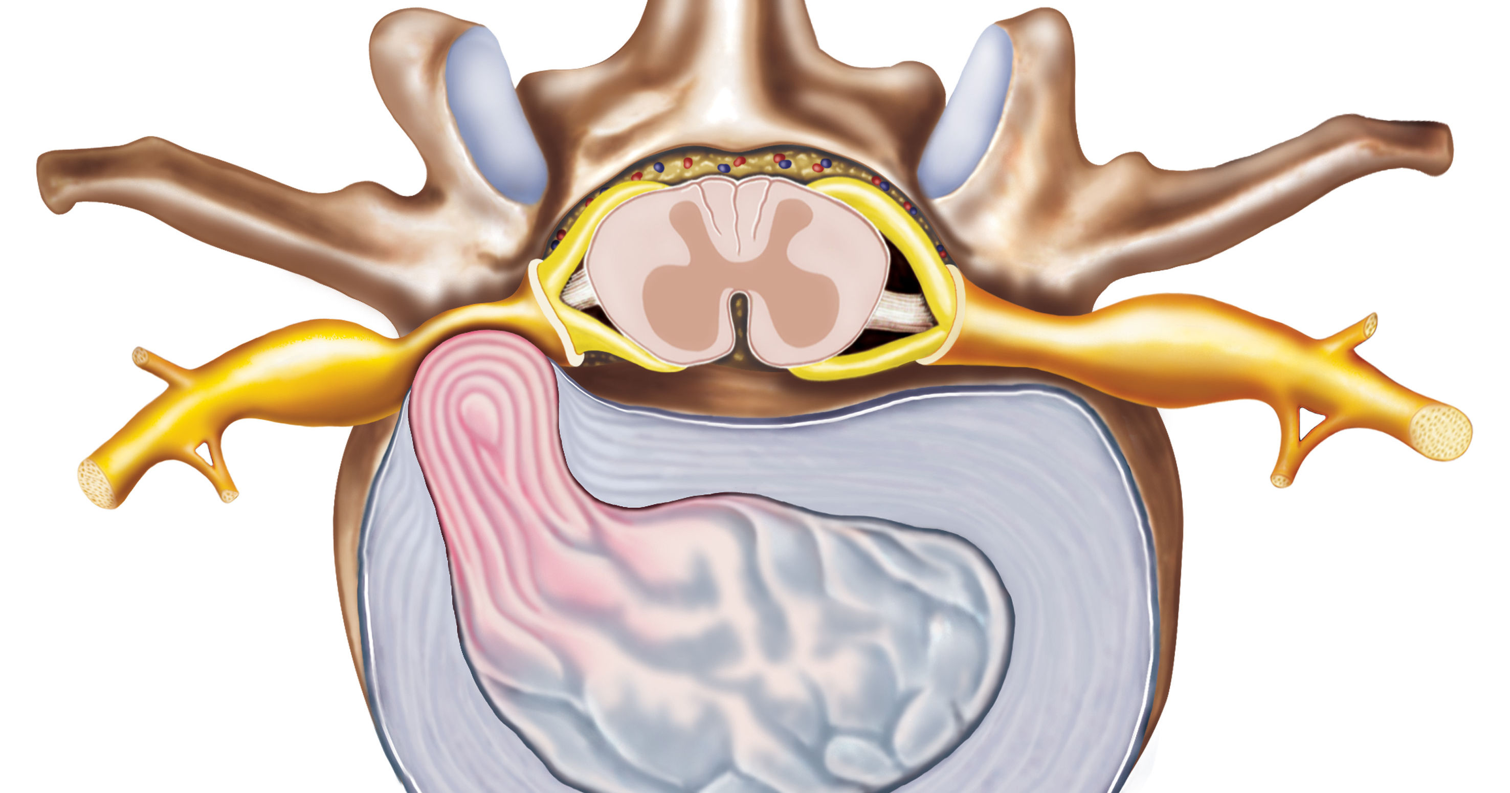 HerniaDisco20