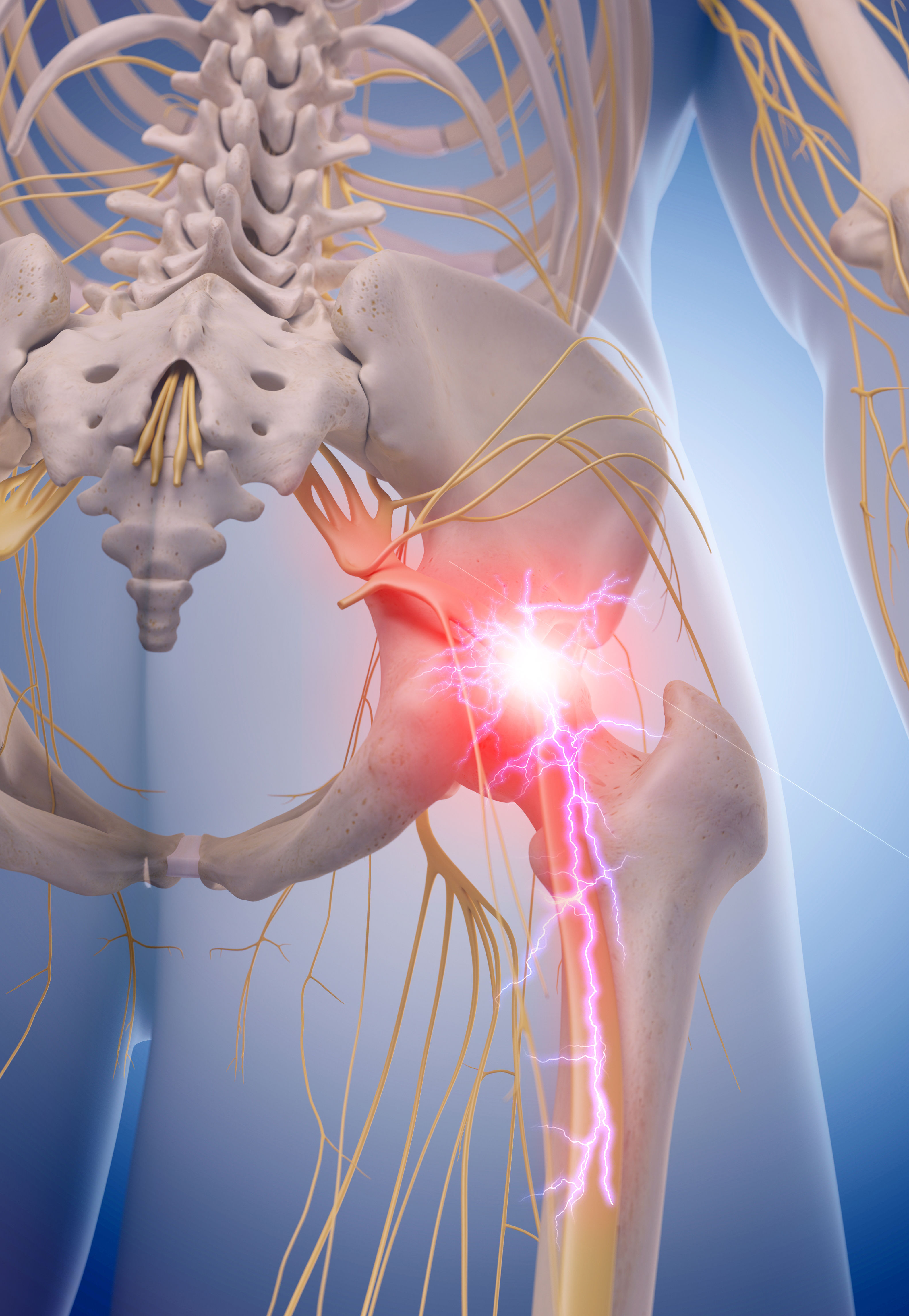 medical illustration of inflamed sciatic nerve