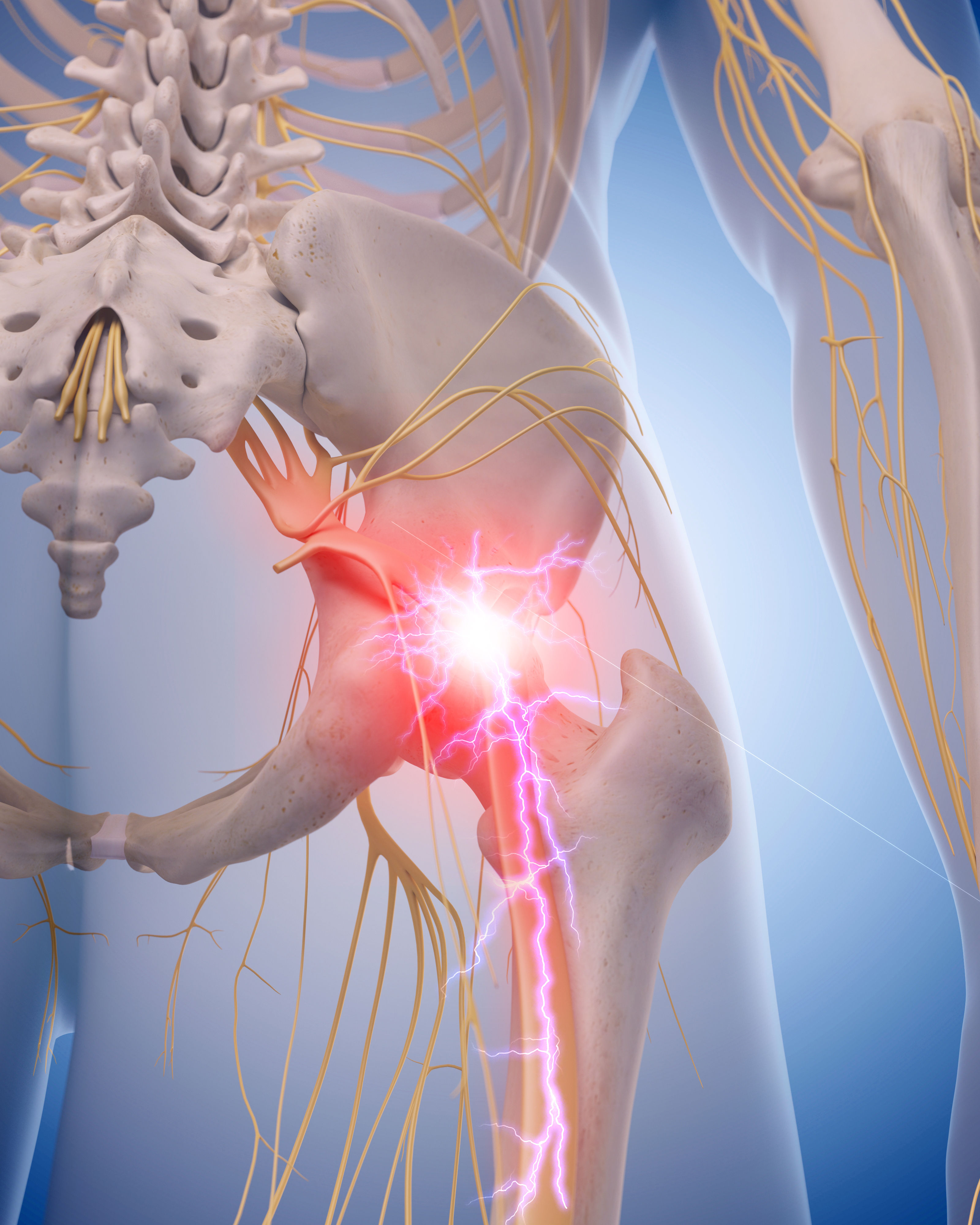 medical illustration of inflamed sciatic nerve