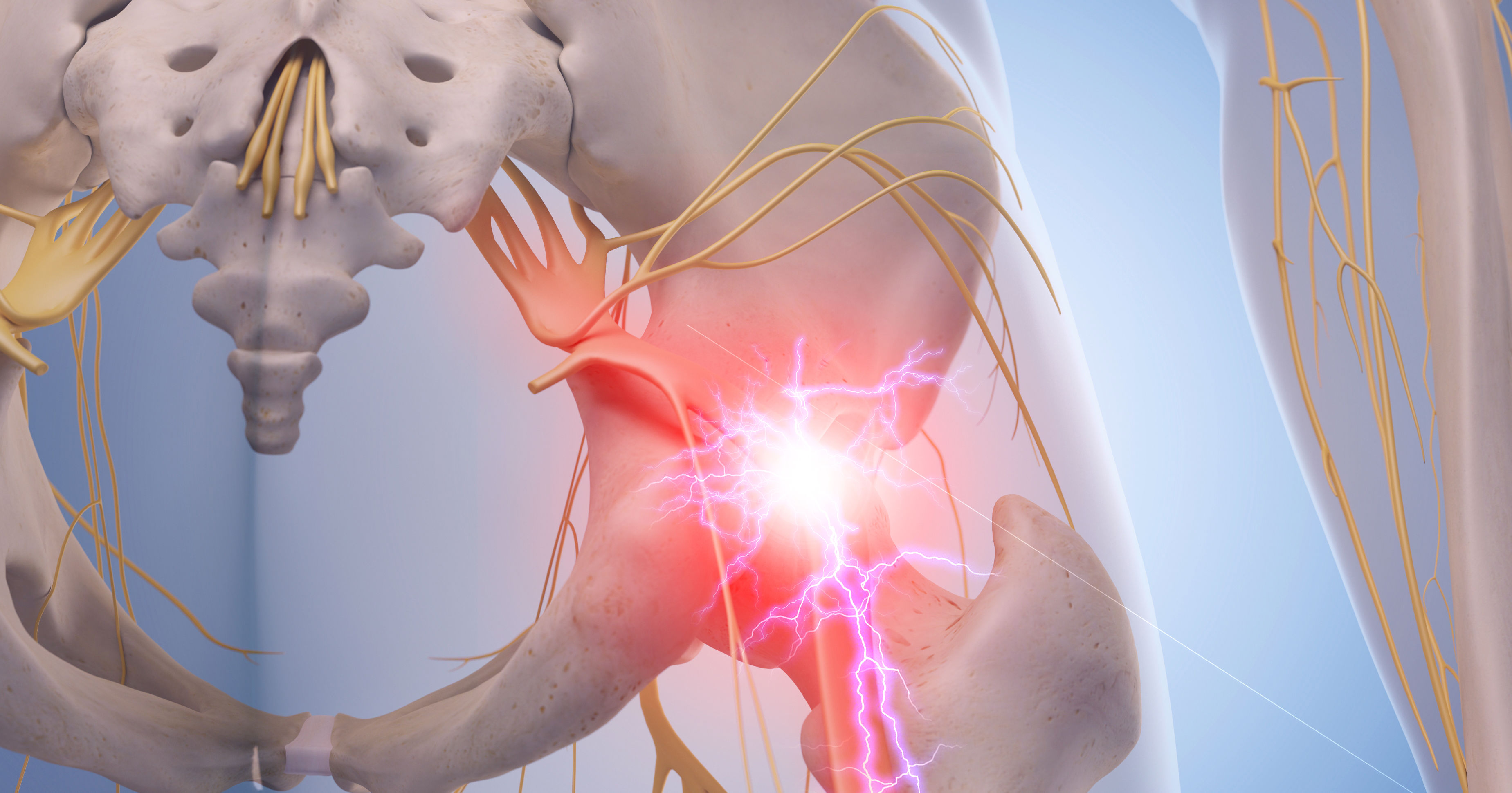 medical illustration of inflamed sciatic nerve