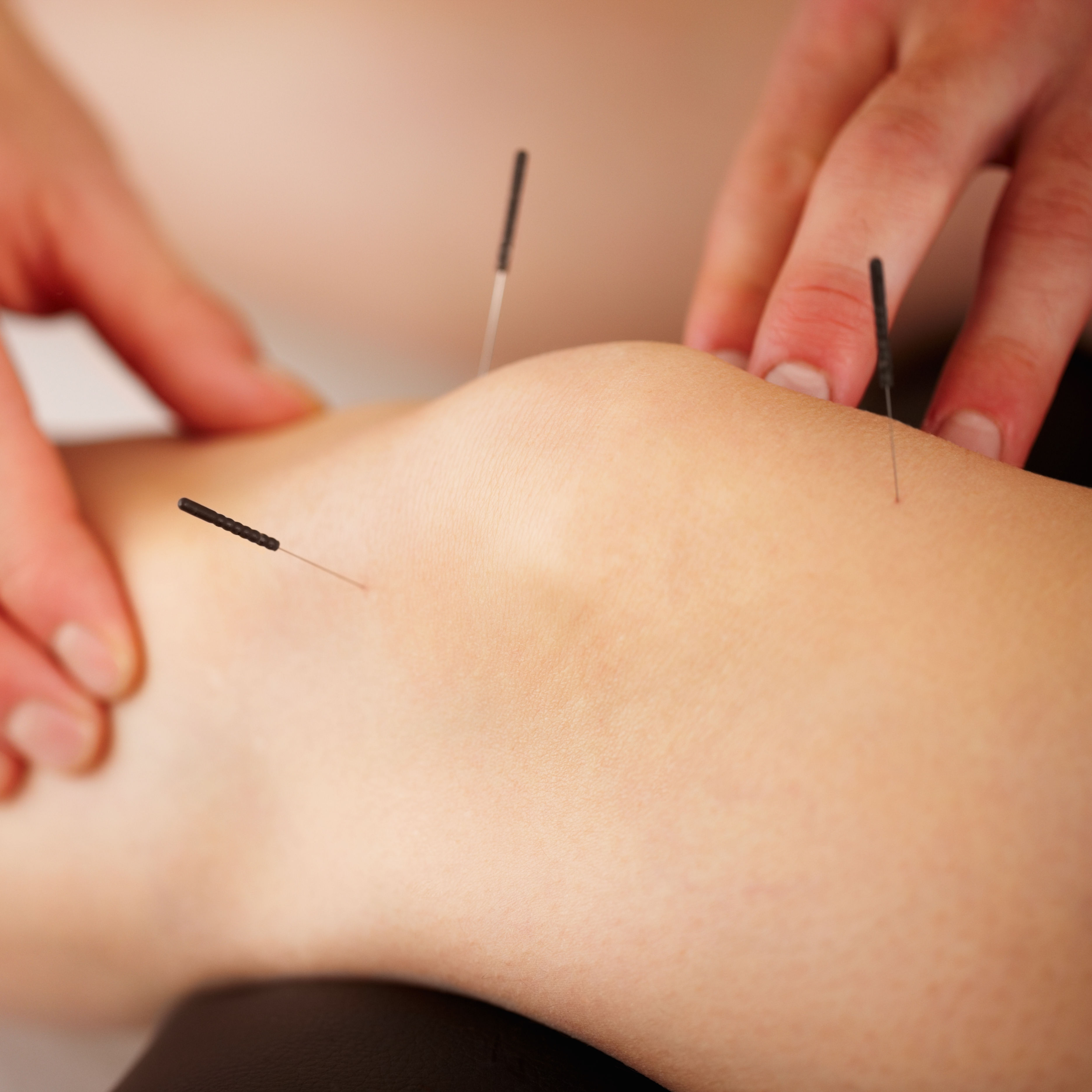 Acupuncture treatment