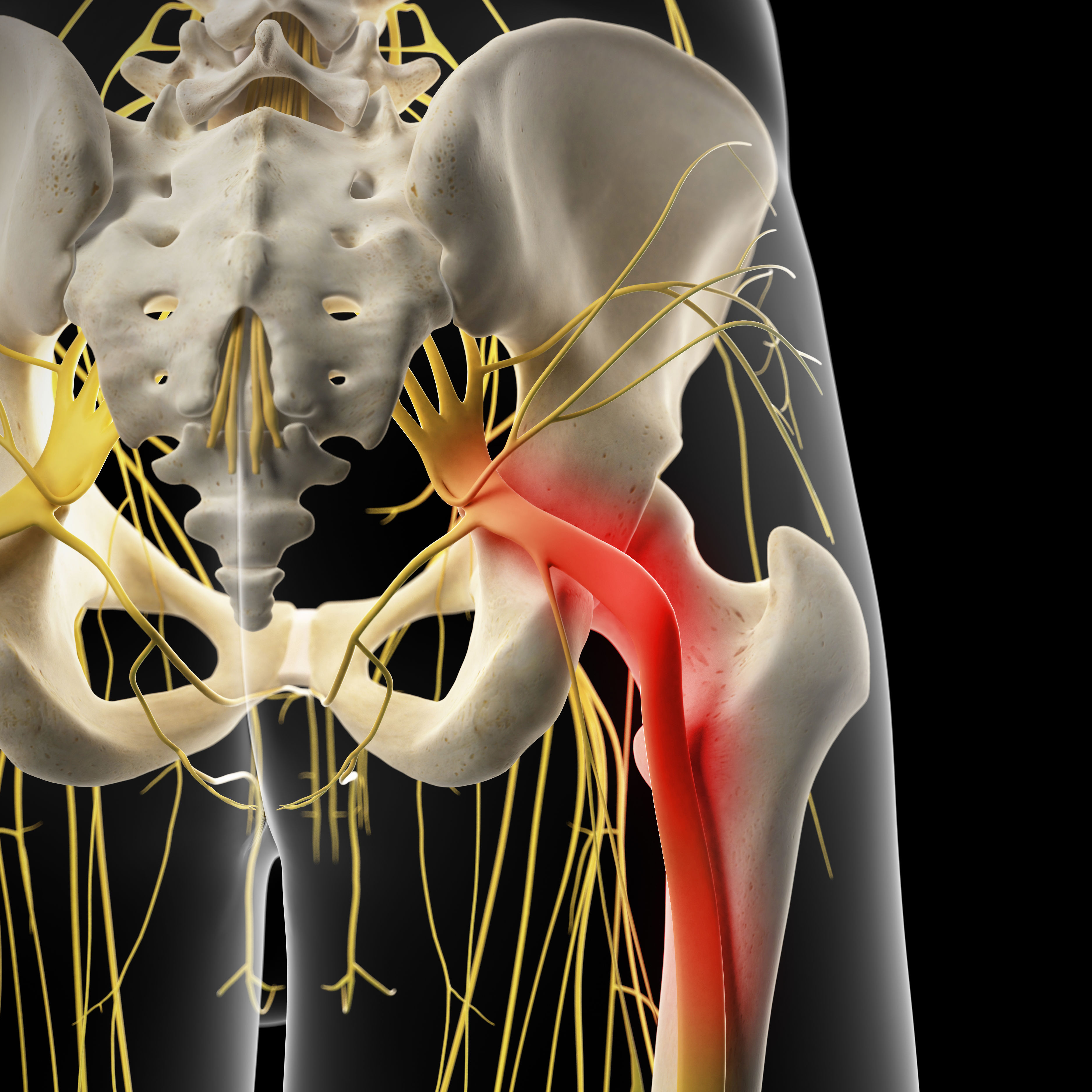 painful sciatic nerve