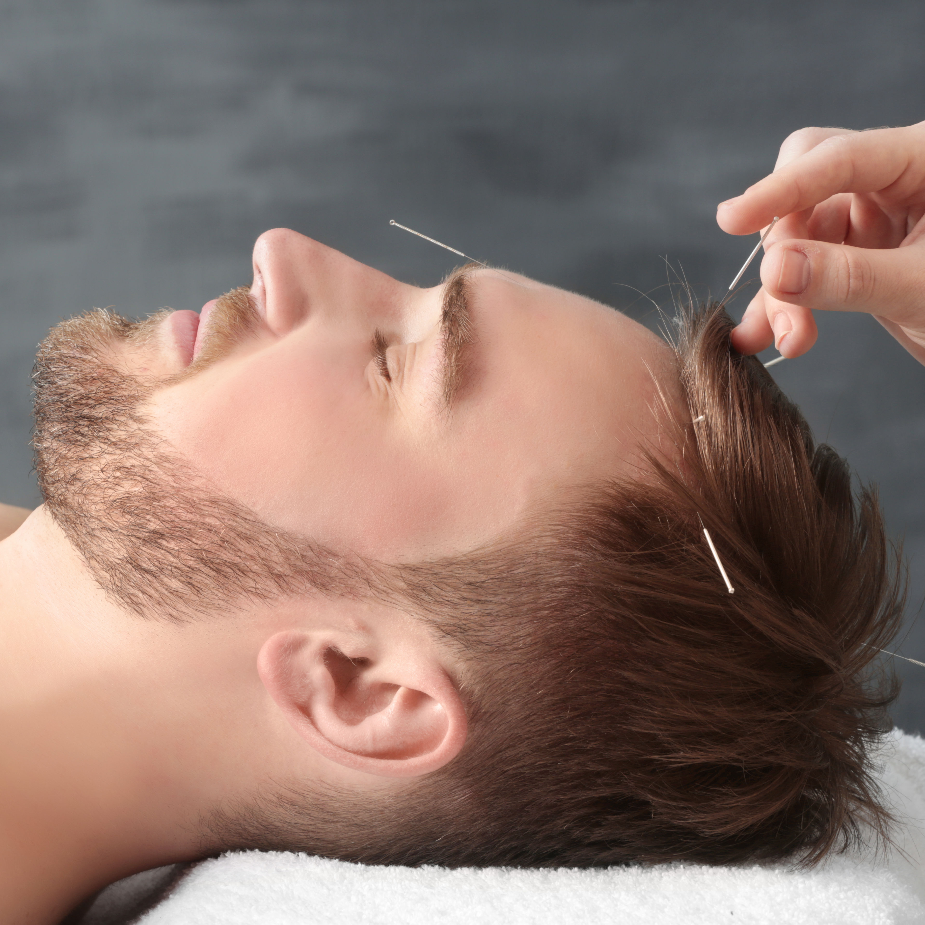 up close left side of face of young white man getting acupuncture in the top of his head