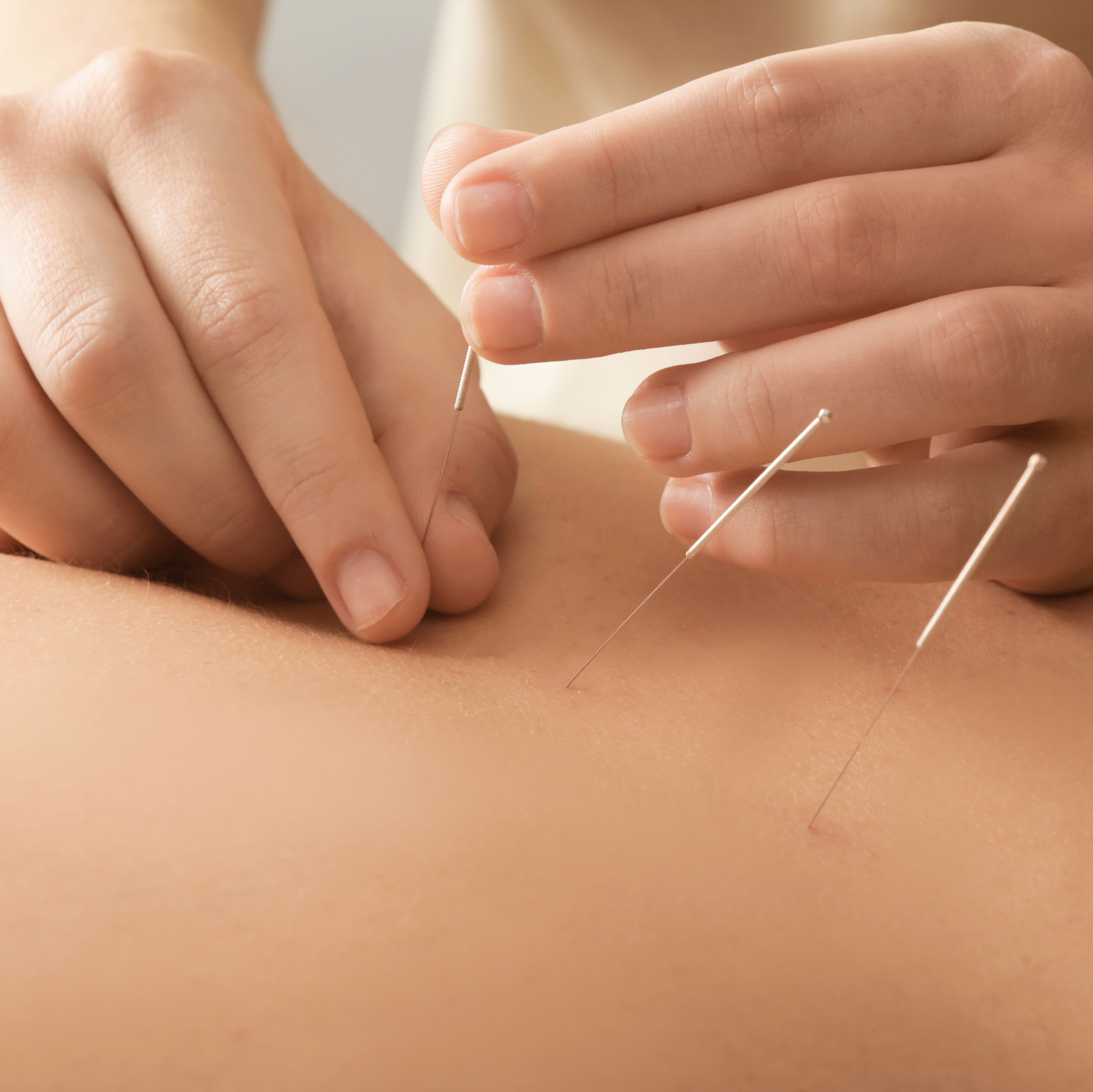 up close of young man getting acupuncture in the middle of his back