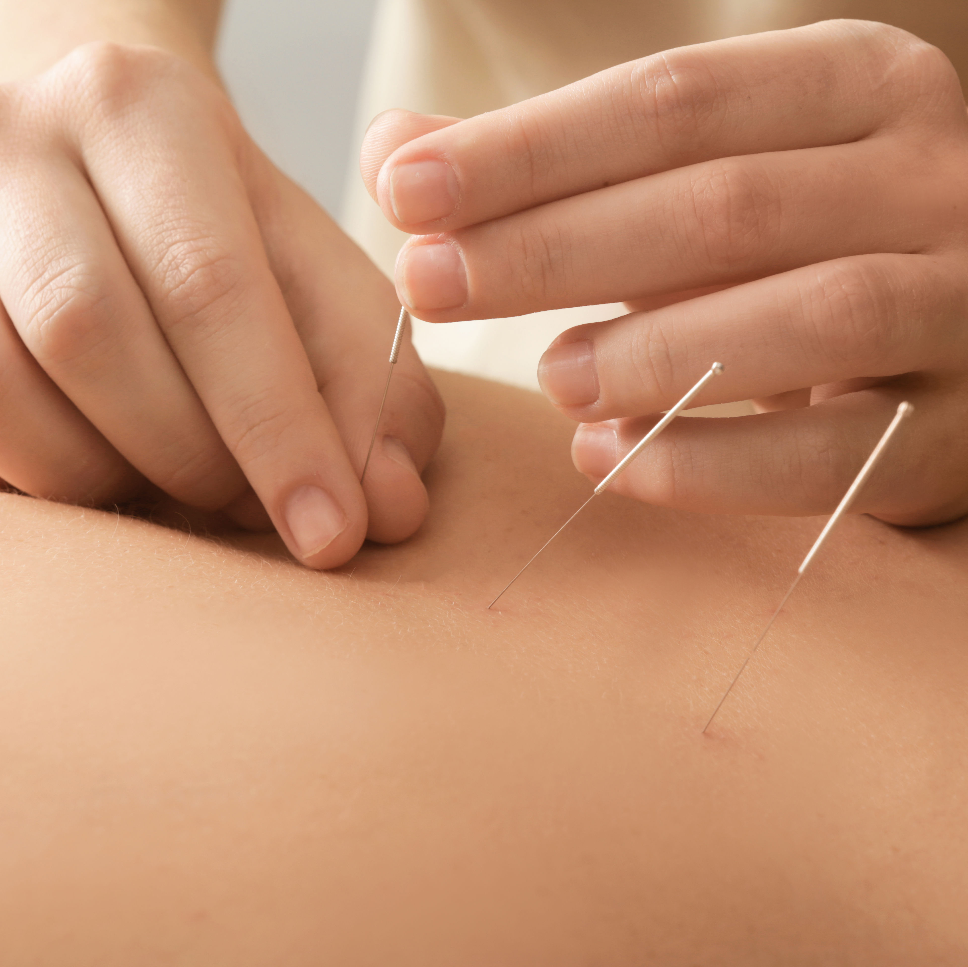 up close of young man getting acupuncture in the middle of his back