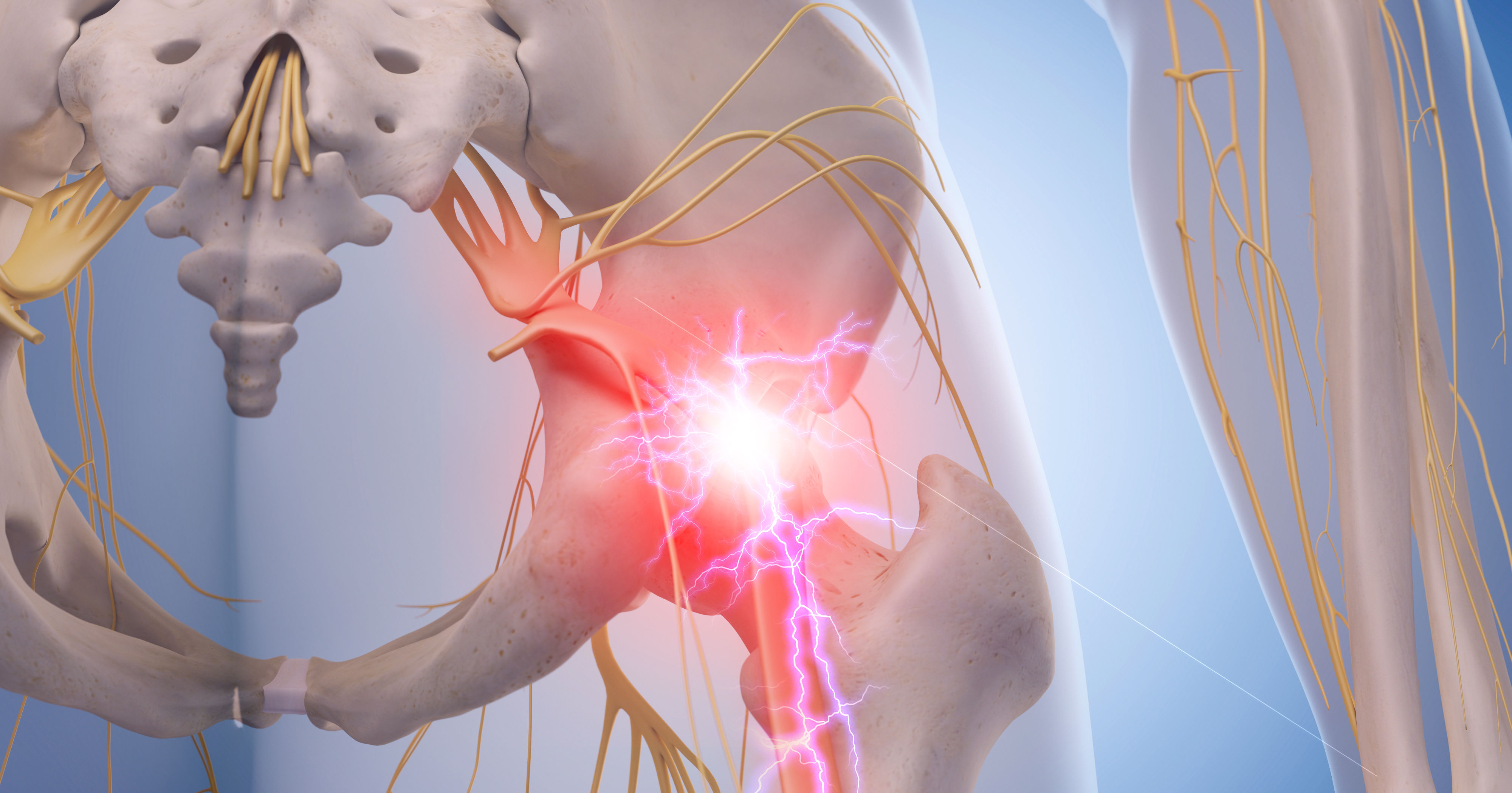 medical illustration of inflamed sciatic nerve