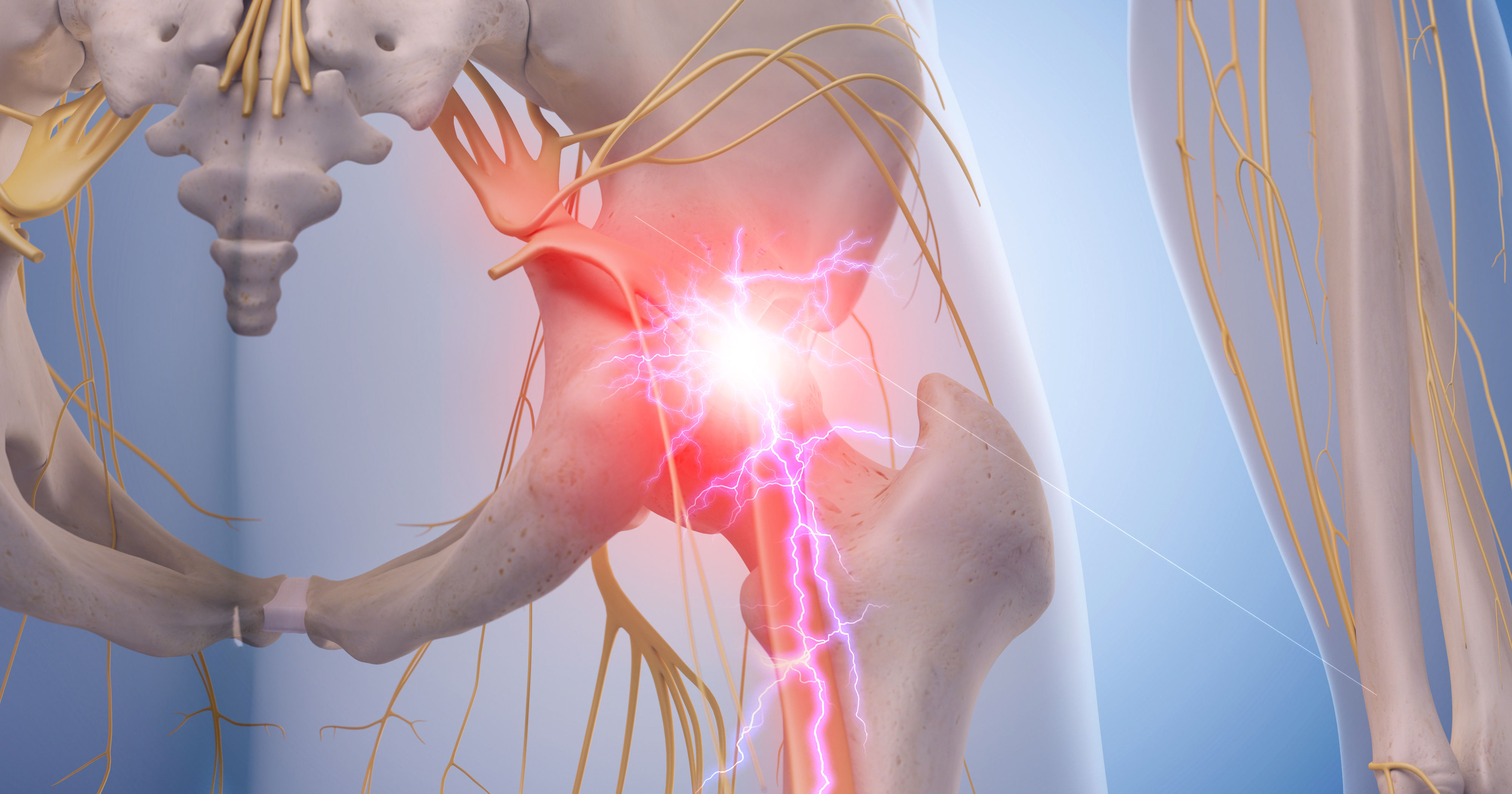 medical illustration of inflamed sciatic nerve