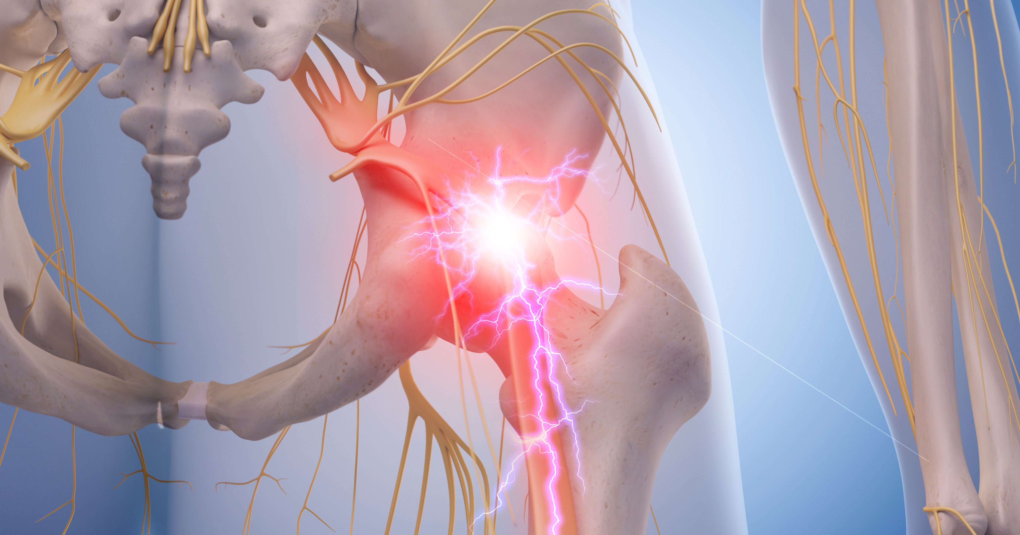 medical illustration of inflamed sciatic nerve
