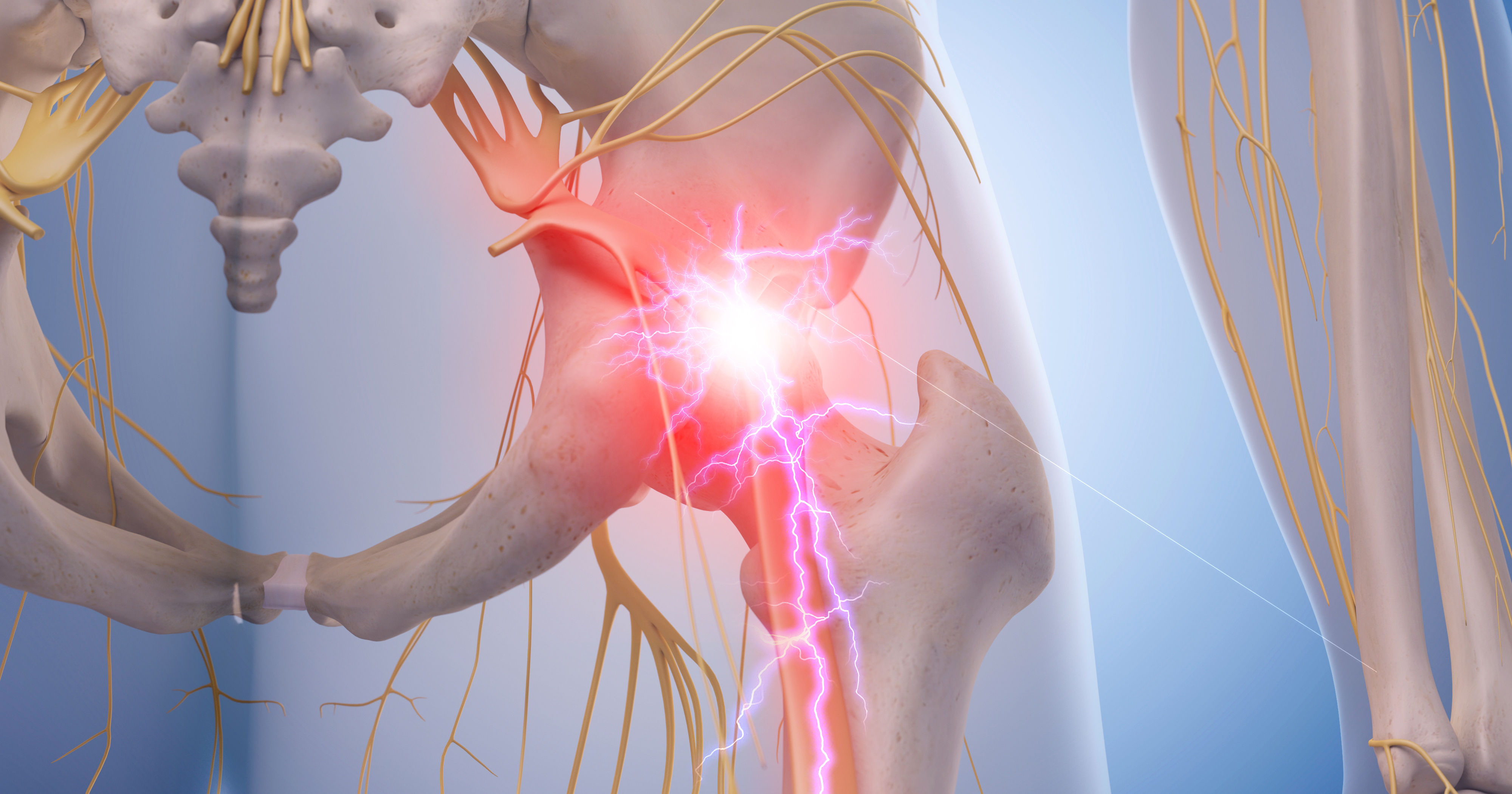 medical illustration of inflamed sciatic nerve