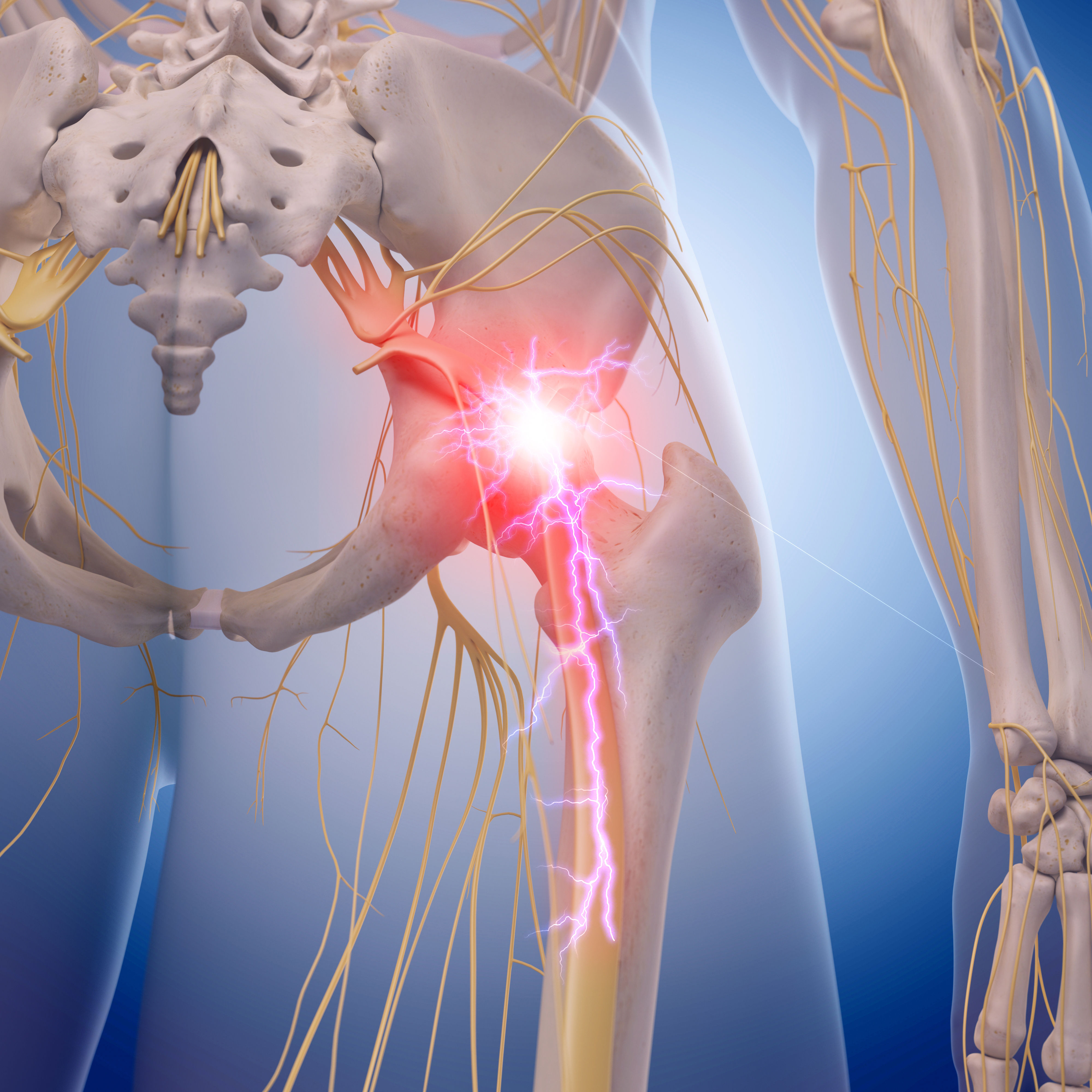 medical illustration of inflamed sciatic nerve