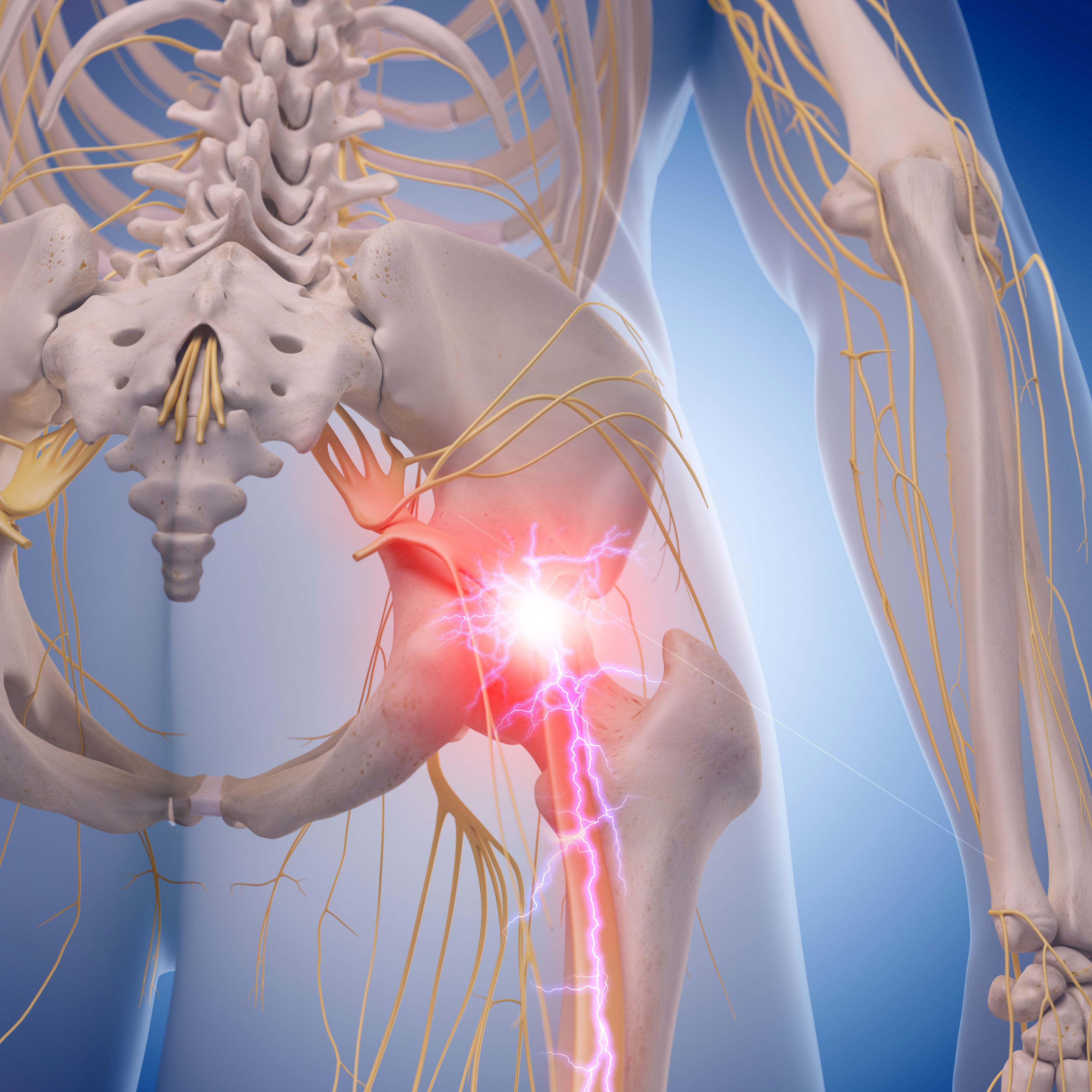 medical illustration of inflamed sciatic nerve