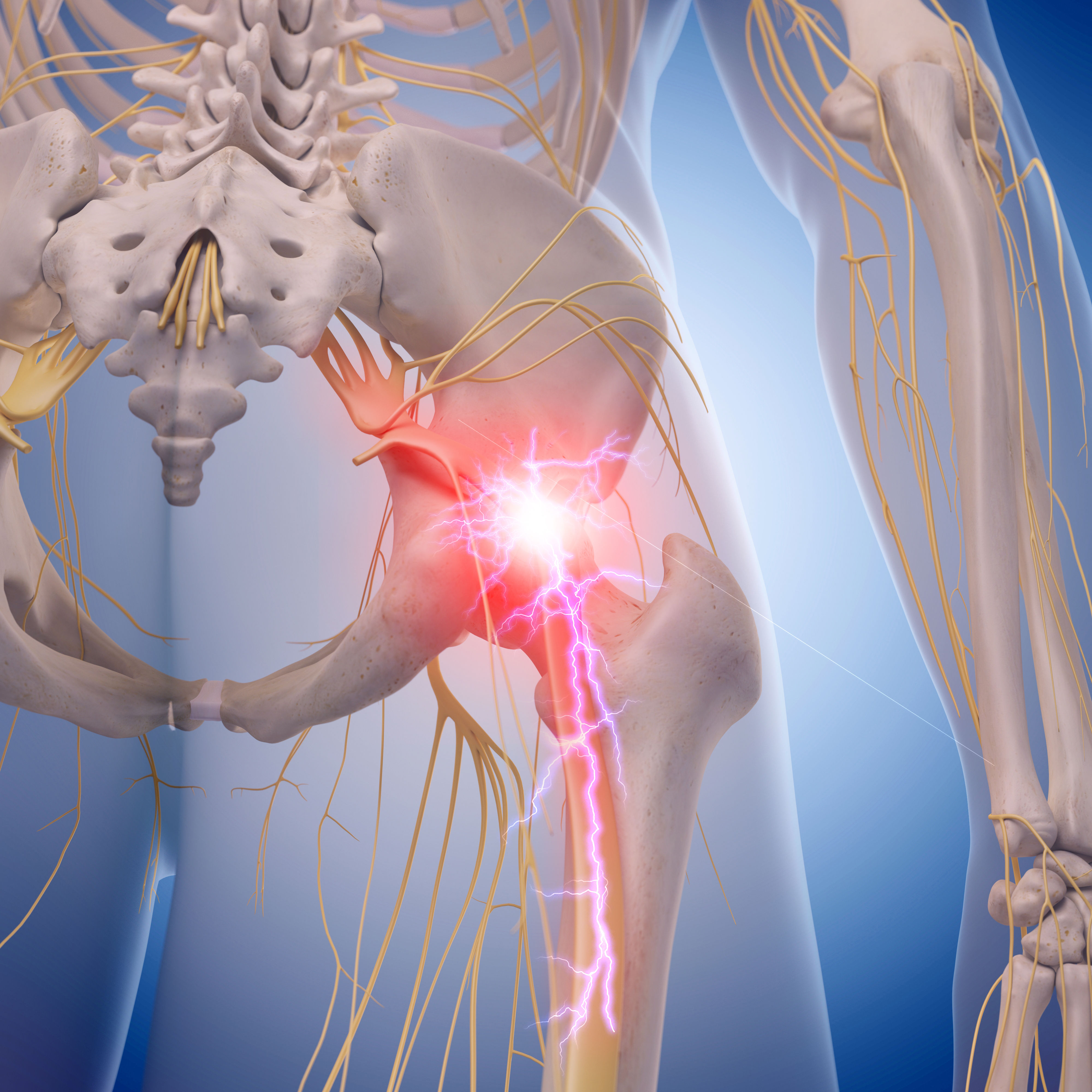 medical illustration of inflamed sciatic nerve