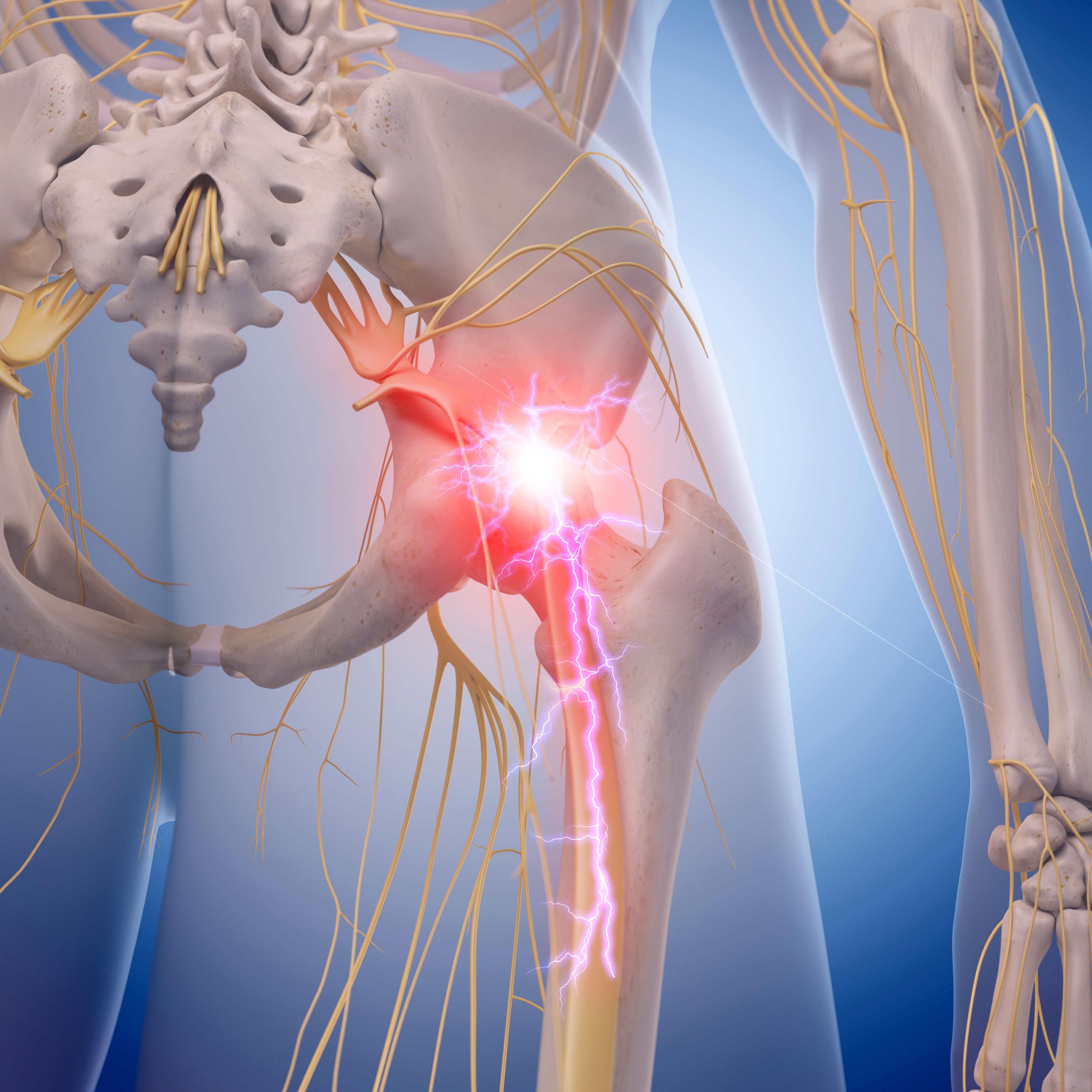 medical illustration of inflamed sciatic nerve