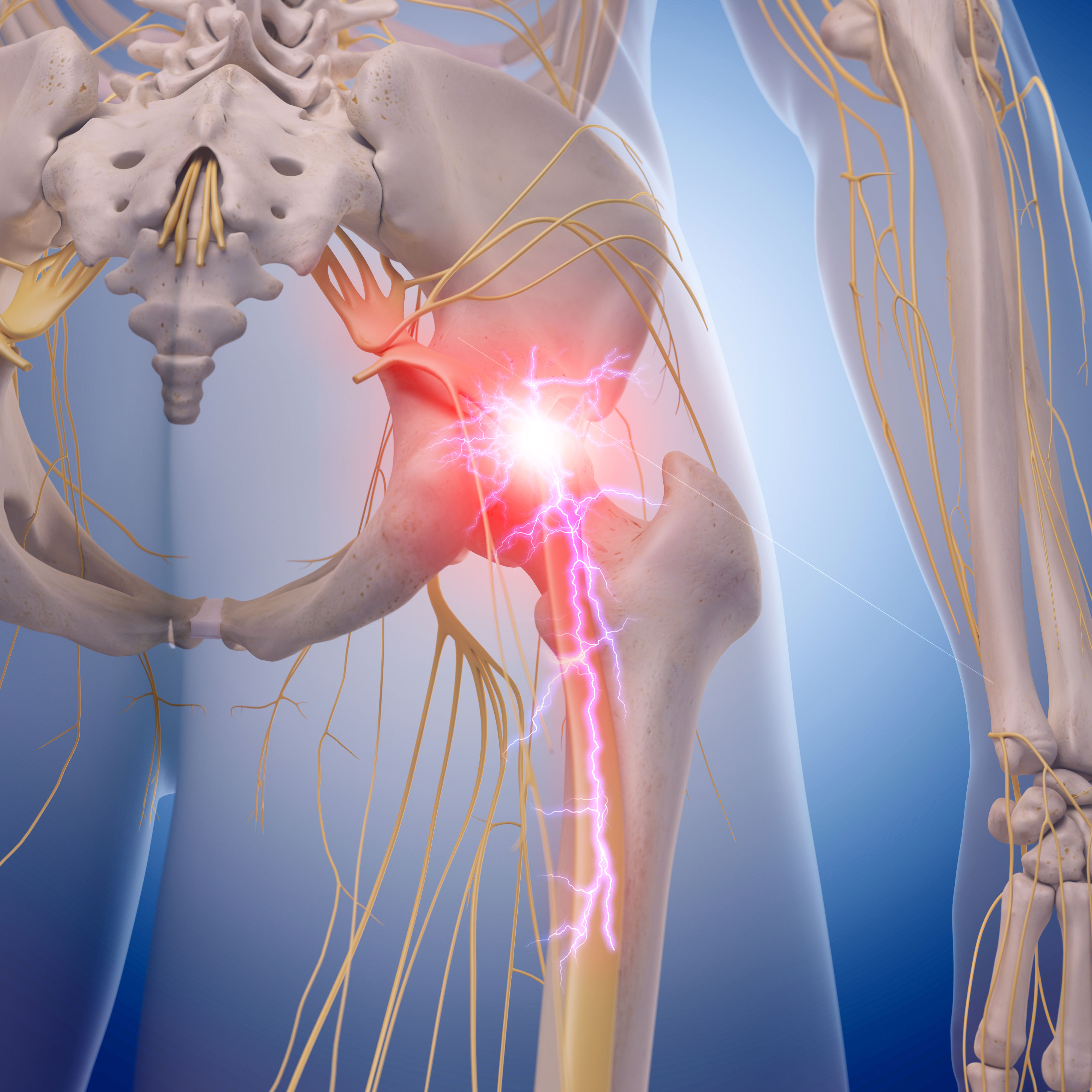 medical illustration of inflamed sciatic nerve