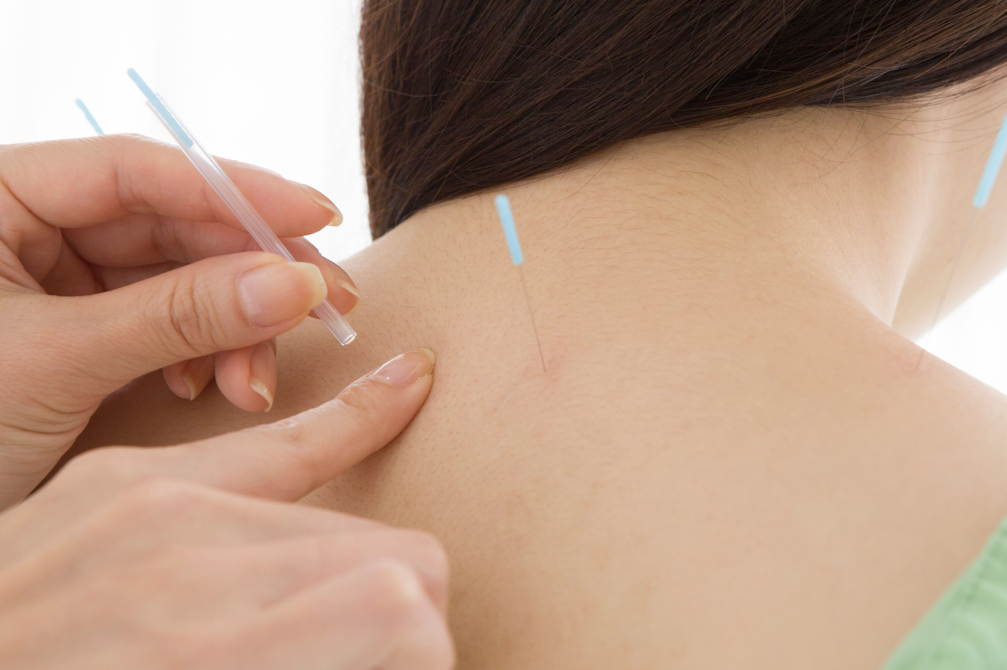 Woman doing acupuncture treatment