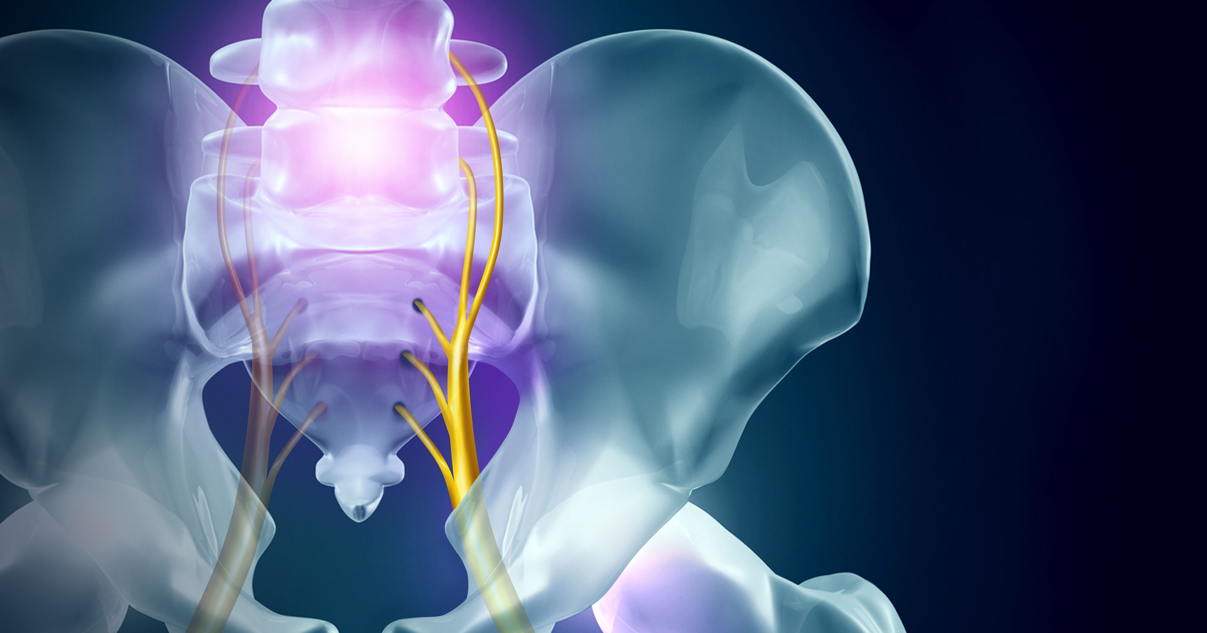 Sciatica Pain