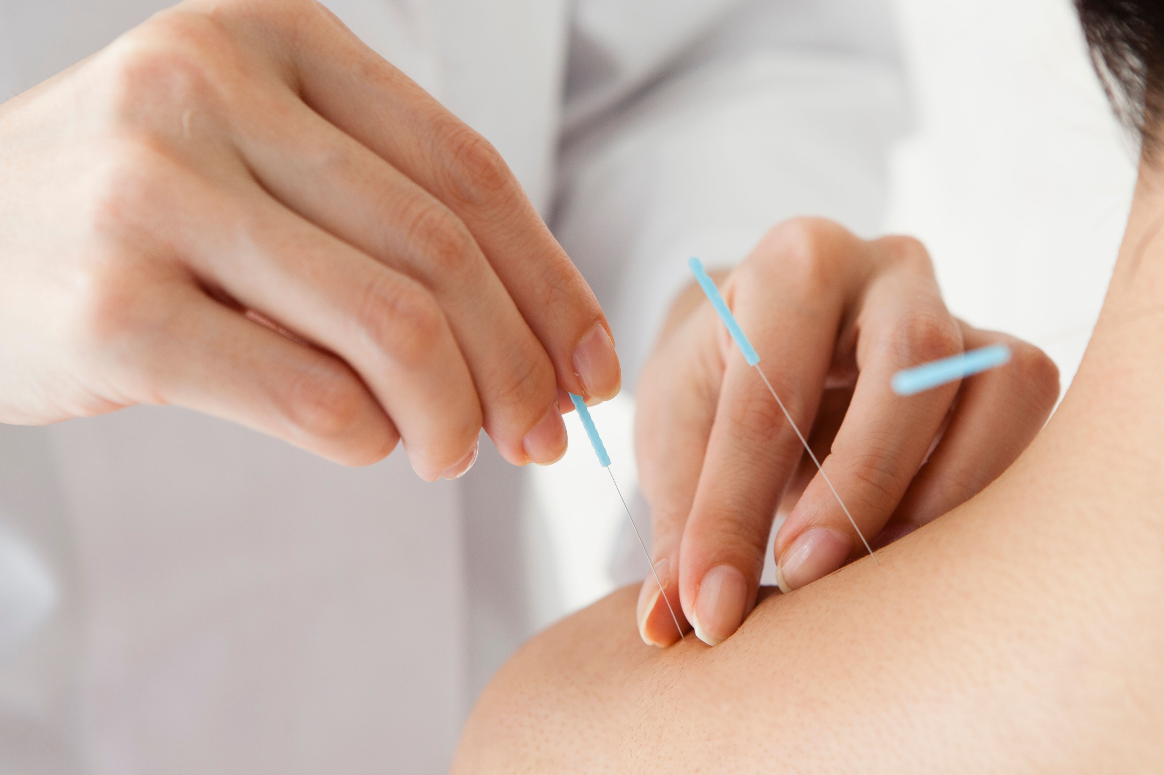 Women receiving acupuncture treatment at a hospita