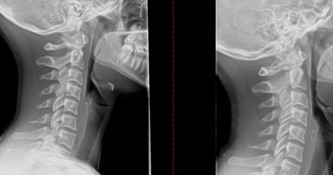 Chiropractor Care Cervical Spine