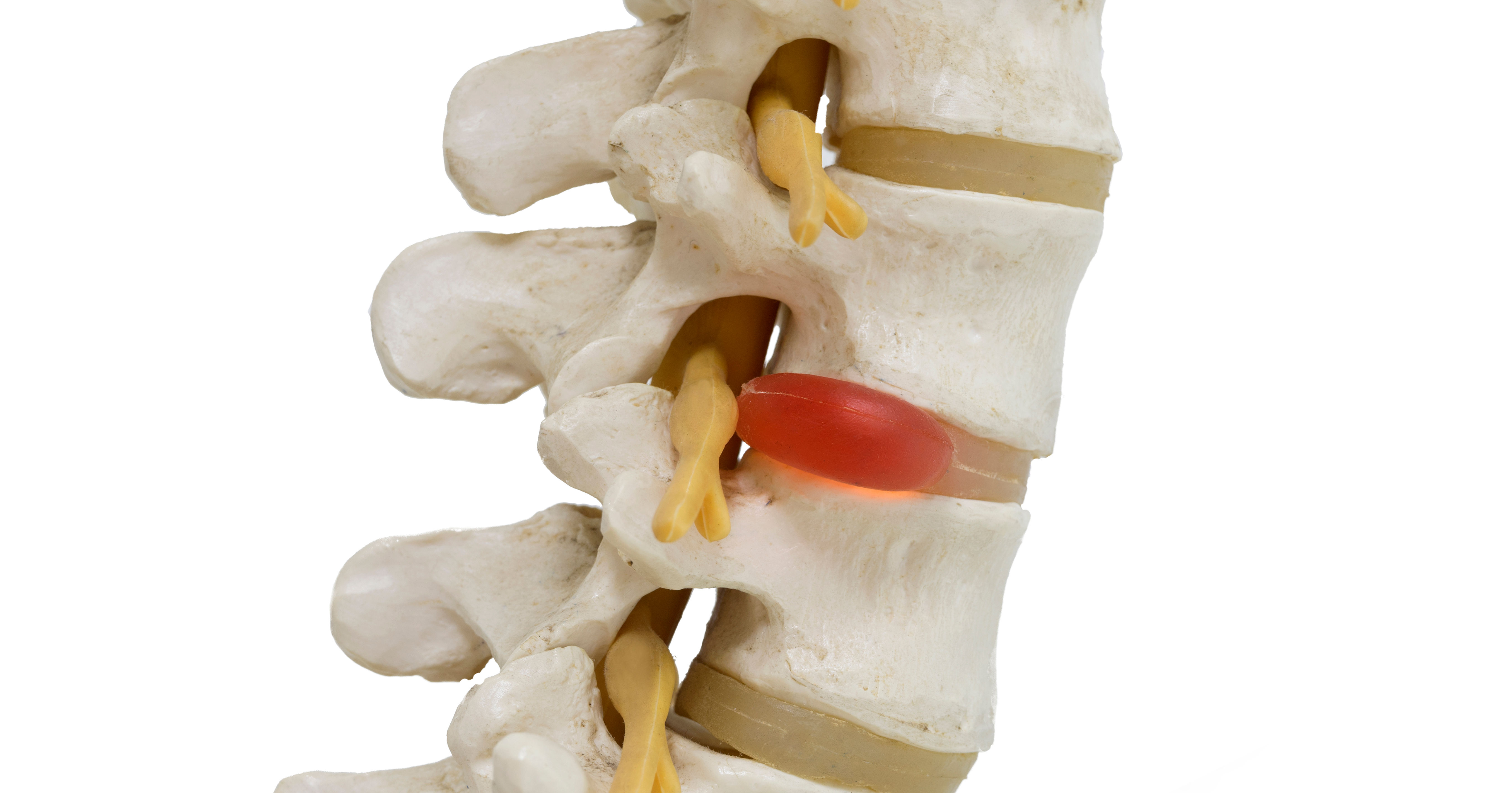 Close-up view of herniated lumbar vertebral disc m